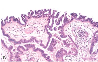 A. SEROUS CYSTADENOCARCINOMA OF THE OVARIES CC/HPI: A 56 year old white nulliparous woman is referred for evaluation of a pelvic mass found on a routine physical.