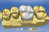 Design multiple single teeth, restorations in opposing quadrants, or even