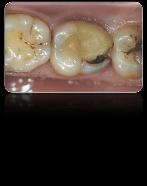 Ceramic inlays and onlays are superior to composite fillings.