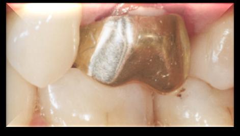 Conventional metal crowns have not only aesthetic