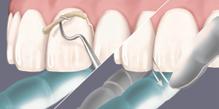 9a -OR- LIGHT CURE FOR LIGHT TRANSMISSIBLE RESTORATIONS Once cleanup is complete, light cure all areas of the restoration for 20 seconds from each direction buccal, lingual, and occlusal.