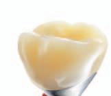 It s an easy choice for an easy sell Functional advantages and unique handling for crowns over implants. It will be easy to sell your dentists on Lava Ultimate Restorative from 3M ESPE.
