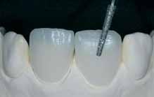 IPS Empress CAD Veneers / Crowns stained/glazed If more intensive and excessive shade adjustments are desired, we recommend conducting them in several working steps.