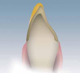 IPS Empress CAD Veneers / Anterior Crowns Cut-back and layered In order to individualize restorations in the incisal area so that they correspond with their natural model, the IPS Empress CAD