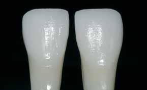 A palatal silicone key is used as a reference for the cut-back. The silicone key should slightly embrace the incisal edge.