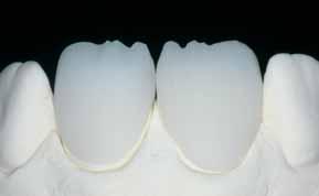 Step 2: Labial/incisal cut-back - volume and length are tapered and reduced Step 3: Mamelon cut-back - design life-like mamelons using abrasive silicone disks at low pressure.