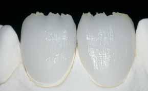 842 F 1543 F 1 st Incisal/Transpa firing with The incisal third is built-up according to the silicone key.