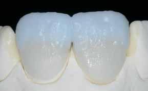 Once the tooth shape has been completed, allow the ceramic material to dry for a short period of time.