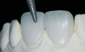 2 nd Incisal/Transpa firing (corrective firing) with After firing, carefully place the restoration on the model and rework.