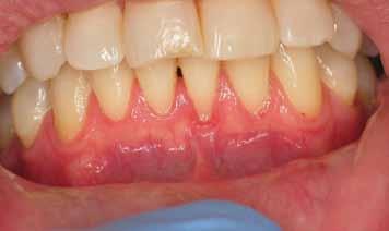 Figure 9: Tooth #24 demonstrates localized gingival recession and insufficient