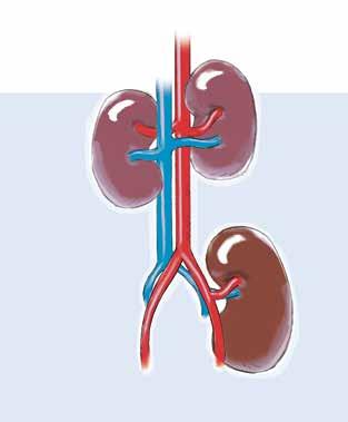 Kidney transplantation What is kidney transplantation?