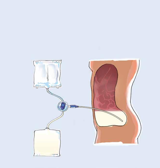 Peritoneal dialysis (PD) treatment Peritoneal dialysis The peritoneal cavity is a space in everybody s abdomen. A thin lining called the peritoneal membrane covers this space.