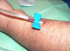 d) Check the flow of blood by pulling up and down on the attached syringe. Your nurse will show you how to do this. e) Place folded gauze under the needle if required. f) Tape needle securely.