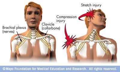 -The reasons behind brachial plexus injury may be delivery or outstretch hand (when somebody stretches his hand then falls on it while stretched) -This picture means that the muscles, which are