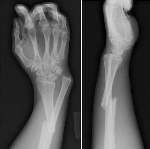 Galeazzi fractures http://www.