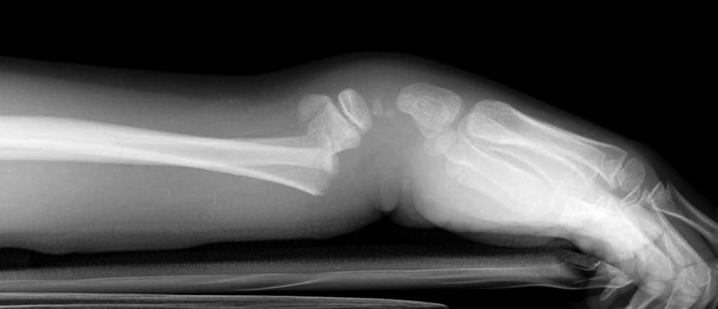 Distal radius fractures http://img.medscape.