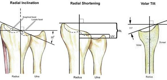 Distal radius fractures http://www.