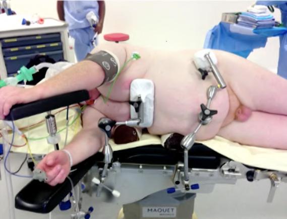 Domi R, Laho H. Anesthetic challenges in the obese patient.