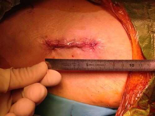 3. Surgical technique Incisions In trauma and elective surgery, the incision size must be adapted to the BMI to provide good exposure and minimize