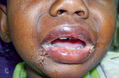 Case summary: A two years old female child brought to our emergency department with a severe form of oral mucositis.