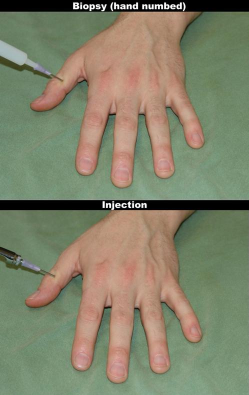 Figure 3. Behavioral data from fmri experiment II. Injections led to high intensity and unpleasantness ratings, while rated pain intensity for the numbed hand stimuli is close to zero.
