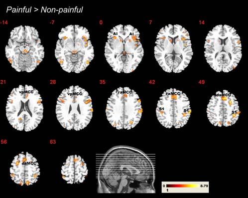 Figure 4. Significant clusters from the random effects contrast painful.