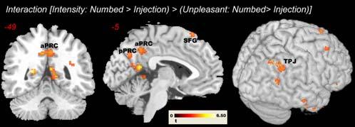 Figure 5. Significant clusters in anterior and posterior precuneus (aprc and pprc) and in the right temporo-parietal junction (TPJ) revealed by the interaction contrast (Intensity: Numbed.Injection).