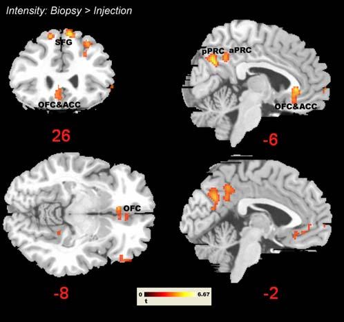 higher susceptibility to emotion contagion (and thus a stronger automatic or bottom-up driven reaction to even the non-painful stimuli) would result in lower activation differences in sensorimotor
