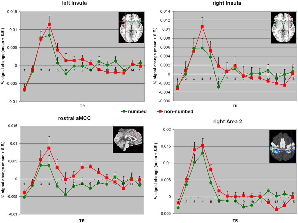 Figure 7. Time-courses in the ROIs (anterior insulae, rostral amcc and contralateral somatosensory cortex/area 2) analyzed in fmri experiment II.