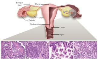 Understand the safety, and cost implications of salpingectomy for ovarian cancer prevention 3.