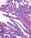 endometrioid/clear cell carcinomas Infection Irritants (e.g.