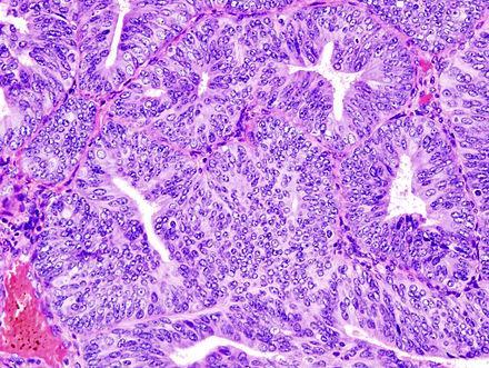Histology Type I Endometrioid, well differentiated Less