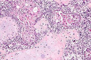 cell, papillary serous, MMMT (carcinosarcoma), poorly