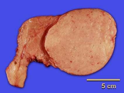 Vaginal Hysterectomy, 1990 10 cm rubbery, light tan tumor, without areas of discoloration, necrosis or
