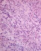 Bland histologic appearance Uterus + Pelvis Lung Soft tissue Bowel Omentum