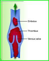 Deep Vein Thrombosis DVT - a clot (thrombus) that forms in a large vein in the leg, pelvis, and arm.