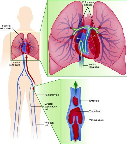 Pulmonary Embolism PE thrombus travel through the right side of the heart to reach the lungs, thrombus lodges in the pulmonary blood vessels (too large to pass through the capillaries of the lungs)