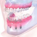 options to help edentulous patients2,3: Straightforward Advanced Complex Removable Fixed Maxilla new