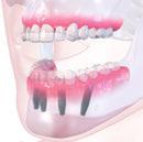 Fixed screw-retained restoration on 6 implants new Mandible LOCATOR on 2 implants Bar with
