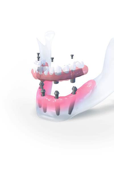 Straumann Pro Arch. Responding to patient expectations.