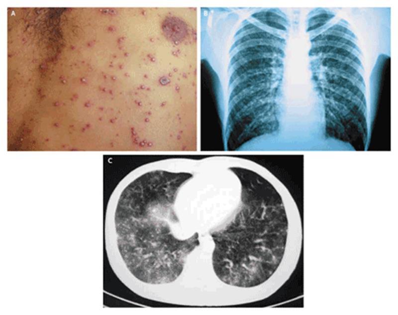 Herpes zoster: Chickenpox