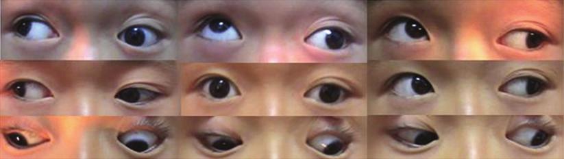 Ophthalmology 5 Table 3: Angles of strabismus of the unaffected eye in patient 10 before and after surgery.