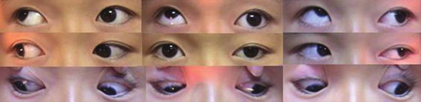 on the contralateral (right) eye X 2 RH 2 X 3 RH 3 6 months after horizontal rectus recession-resection on the contralateral (right) eye X 2 RH 2 X 2 RH 1 APRMT: augmented partial rectus muscle
