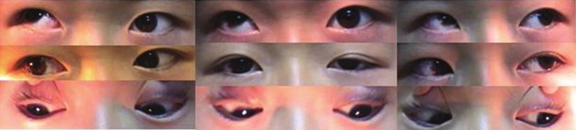 001 After operation (a) Figure 3: Comparison of the angle of strabismus while looking at far objects (6 m) before APRMT and at the 6-month follow-up.