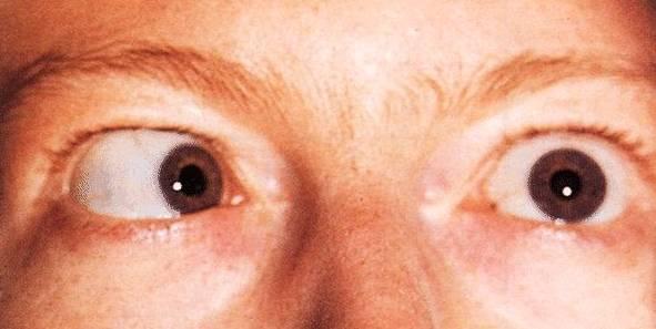 Abducent nerve (VI) Strabismus en diplopia Weakness or paralysis of ipsilateral lateral rectus cannot abduct past midline (LMN lesion) Several mechanisms: