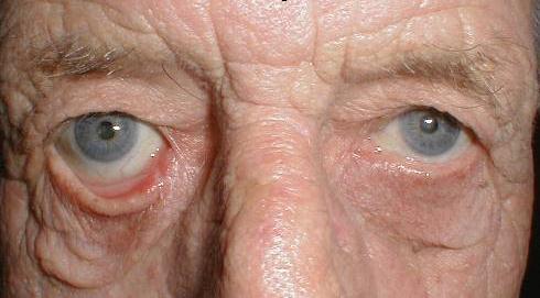 Facial nerve palsy Paralysis of orbicularis oculi closure of eyelids Ectropion