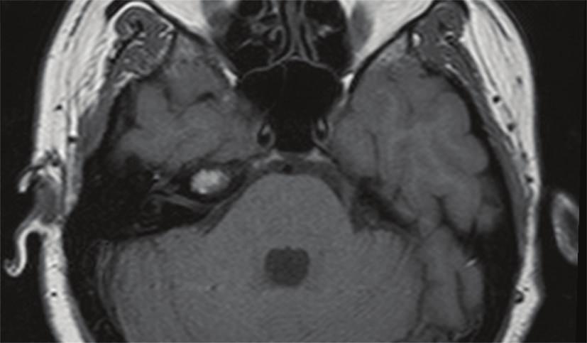 2 Case Reports in Otolaryngology Figure 1: Axial T1-weighted image shows a hyperintense lesion in the right petrous apex.