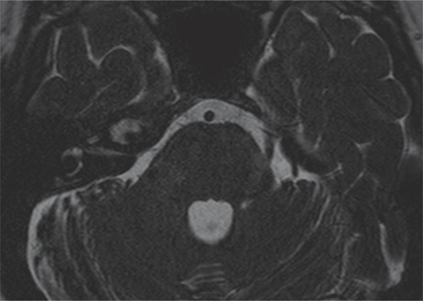 Figure 2: Axial T2-weighted image showes a hyperintense lesion in the right petrous apex. Figure 4: Axial CT scan showes an osteolytic lesion involving the right petrous apex.