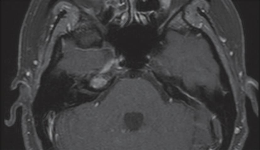 With the aid of neuronavigation and intraoperative MRI (1,5-T magnet, Magnetom Sonata, Siemens AG, Medical Solutions, Erlangen, Germany; T1- weighted sequences before and after administration of
