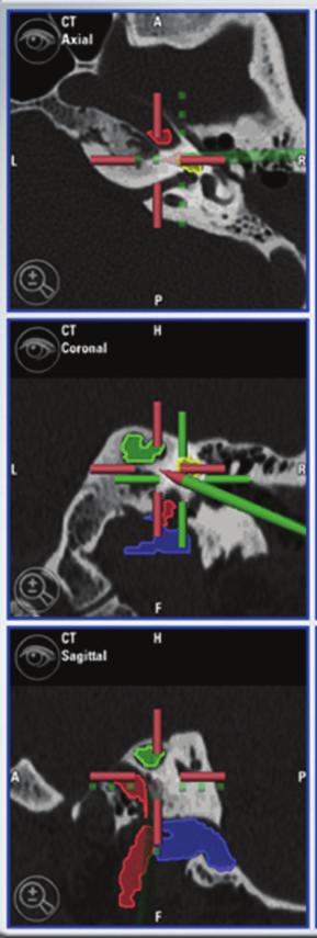 Case Reports in Otolaryngology 3 Figure 5: Intraoperative screenshot shows the direction of drilling and the relationship between the surgical route and the surrounding structures (blue: jugular